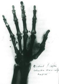 Röntgen Hand von Kölliker