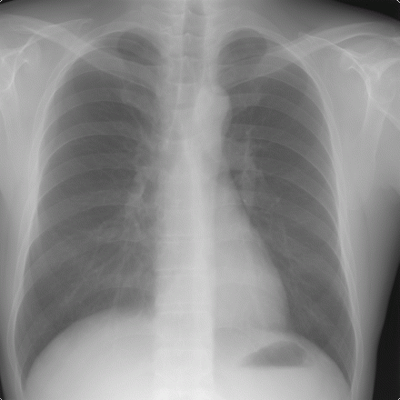 Röntgen Thorax